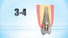 Fig 3. 3 to 4 mm is the distance apically from the restorative platform to the buccal-gingival margin.